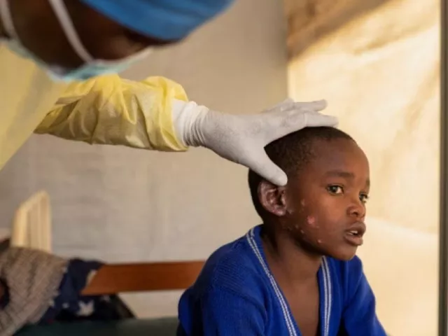 dr tresor wakilongo verifies the evolution of skin lesions on the ear of innocent suffering from mpox an infectious disease caused by the monkeypox virus that sparks off a painful rash enlarged lymph nodes and fever at the treatment centre in munigi following mpox cases in nyiragongo territory near goma photo reuters dr tresor wakilongo verifies the evolution of skin lesions on the ear of innocent suffering from mpox an infectious disease caused by the monkeypox virus that sparks off a painful rash enlarged lymph nodes and fever at the treatment centre in munigi following mpox cases in nyiragongo territory near goma photo reuters